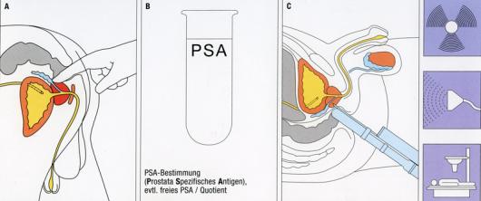 Σχήμα 3.1: Διαγνωστική του καρκίνου του προστάτη