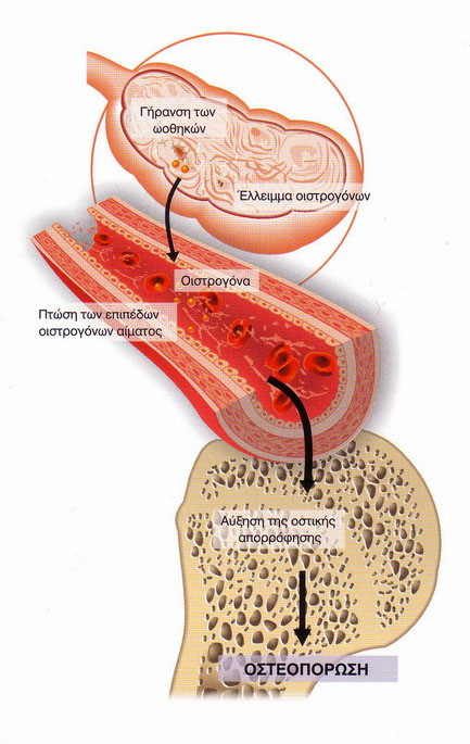 osteoporosi1